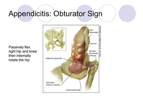 Acute Abdominal Pain Ms Lecture Ppt