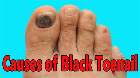 Causes Of Black Toenail How To Get Rid Of A Black Toenail Cure Of