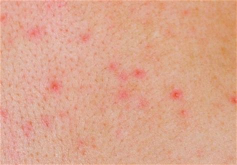 Eczema, dermatitis, neurodermatitis, urticaria, herpes zoster, streptoderma, bacterial, fungal and viral lesions, demodicosis (demodex), molluscum contagiosum and other skin disease. Skin Rashes. Causes, symptoms, treatment Skin Rashes
