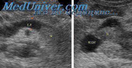 Жировая инфильтрация печени лечение диета УЗИ сегментарной анатомии печени. Жировая инфильтрация печени УЗИ сегментарной анатомии печени. Жировая инфильтрация печени Жировая инфильтрация печени лечение диета