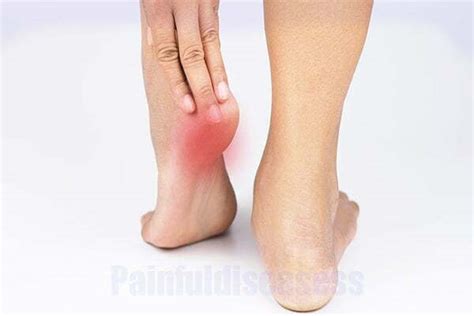 Painful Bump On Bottom Of Heel Symptoms And Treatment Painful Diseases