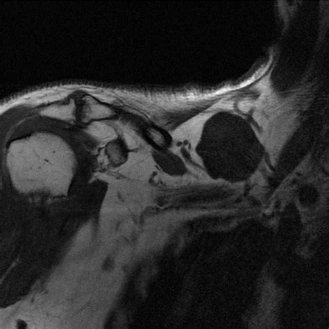 T1 Weighted Mri Sequence Showing A Supraclavicular Cyst Download