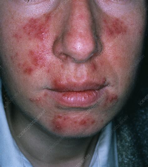 Rosacea Stock Image M2500040 Science Photo Library