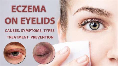 Eczema On Eyelids Eczema On Eyelids Type Treatments Music Therapy