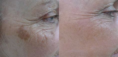 Acd A Z Of Skin Laser Resurfacing Fully Ablative