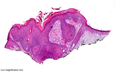 Pathology Outlines Inverted Follicular Keratosis