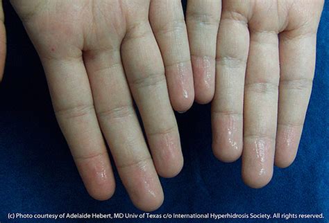 Sweaty Hands International Hyperhidrosis Society Official Site