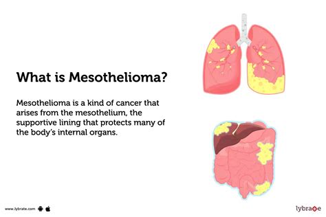 Mesothelioma Causes Symptoms Treatment And Cost