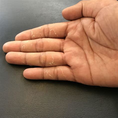 Fingertips Peeling 5 Tips To Get Rid Of Peeling Skin From Fingertips