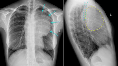 The Chest Radiograph Shows A Large Superior Mediastinal Mass Which Is