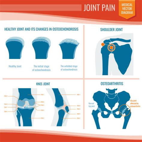 Osteoporosis Hip Illustrations Royalty Free Vector Graphics And Clip Art