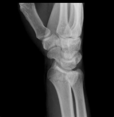 Distal Radius Fractures With Intra Articular Component Image