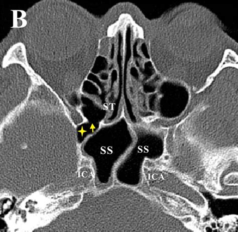 Posterior Ethmoid Cell Expansion Towards The Inferolateral Region Of