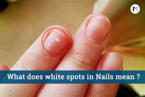 What The White Spots On Your Nails Actually Mean Marham