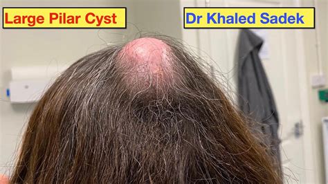 Massive Pilar Cyst Removal Dr Khaled Sadek Youtube