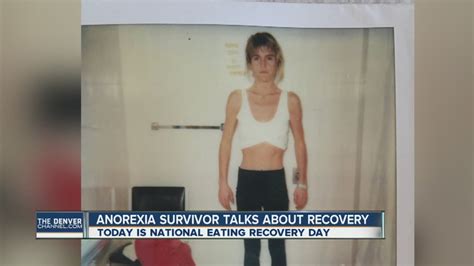 Denver Anorexia Survivor Wants To Help Others Battling Eating Disorders