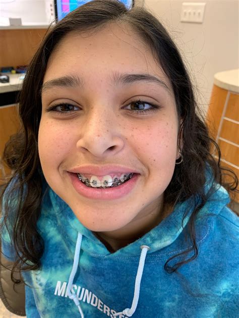 How Much Do Braces Cost Find Affordable Braces At Kool Smiles