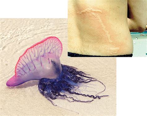 Stinging Jellyfish Clue