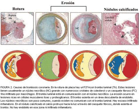La trombosis coronaria se produce cuando una arteria en el corazón se bloquea por un trombo o coágulo de sangre. Trombosis coronaria