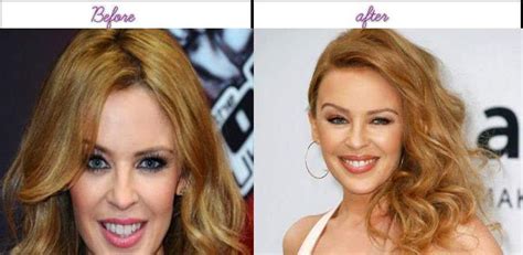 Kylie minogue is recognised as the best selling australian artist of all time. Best After Before Plastic Surgery Photos Of Kylie Minogue ...