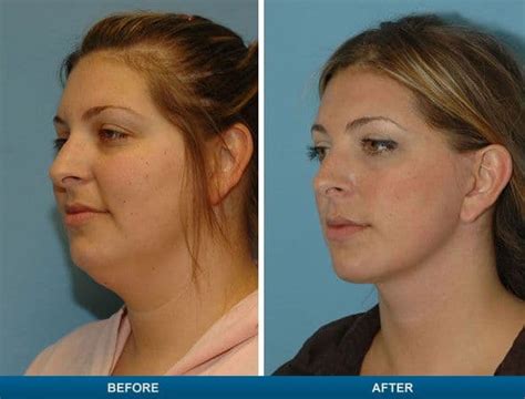 Double Chin Plastic Surgery Before And After