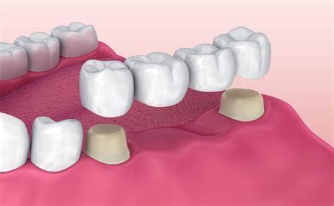 What Are The Three Main Types Of Dental Bridges