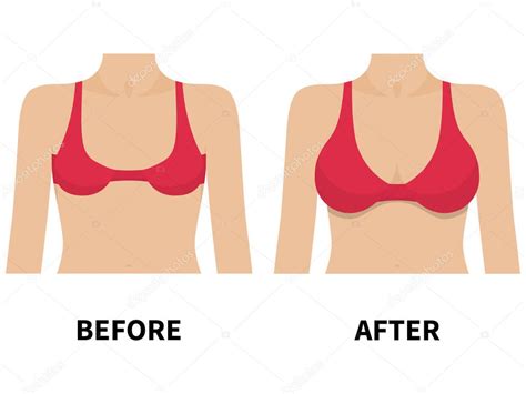 Kadın meme önce ve sonra plastik cerrahi Stock Vector by jenyakot86