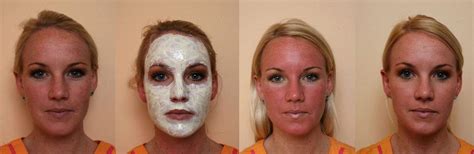 Dark Spots On The Skin Causes Treatments And Remedies