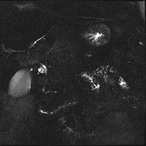 Hepatic Hemangioma Atypical On Ultrasound Hepatic Steatosis Image