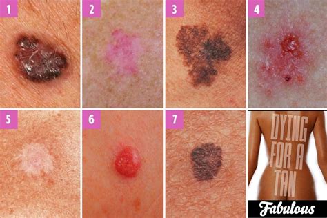 What Does Skin Cancer Look Like At The Beginning