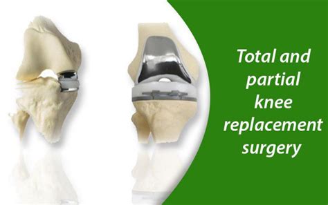 Total Knee Replacement Surgery Vs Partial Knee Replacement Surgery