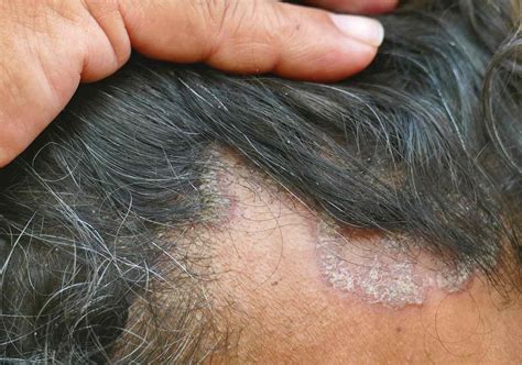Dermatite Séborrhéique Vs Psoriasis Différences Entre Le Cuir Chevelu