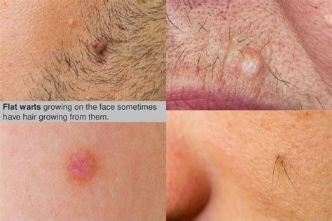 How To Recognize A Wart