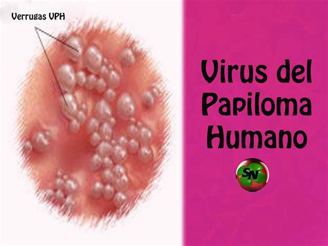 Cómo saber si usted padece VPH virus de papiloma humano