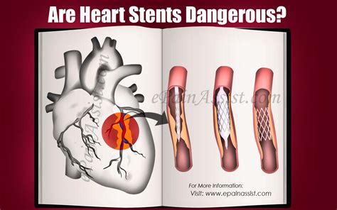 Heart Stents Procedure