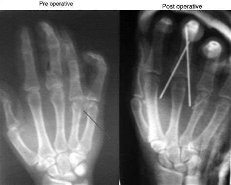 Pilon Fractures Of Middle Phalanx Managed With Lag Screw And Early