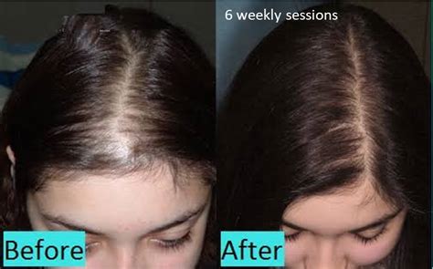 Hair And Scalp Treatment Dermaroller Micro Needling Collagen
