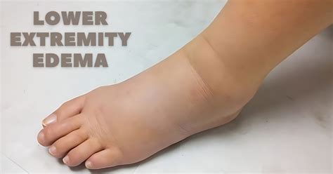 Treat Your Lower Extremity Edema Without Losing Calf Muscles Sri