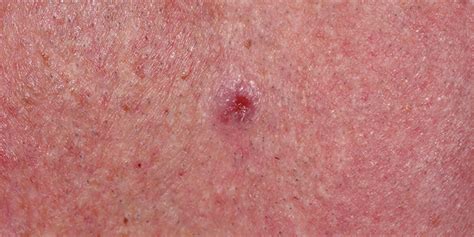 It is more frequent in the elderly, it occurs most frequently the head and neck region, and it is associated with sunlight exposure. Merkle Cell Carcinoma | Skin Cancer and Reconstructive ...