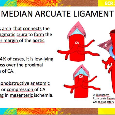 Median Arcuate Ligament Syndrome Median Arcuate Ligament Syndrome
