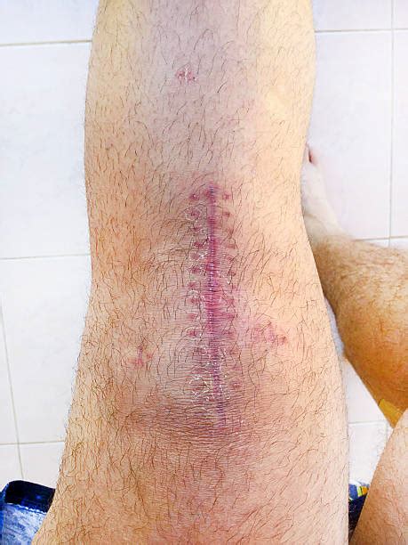 50 Scar Human Skin Human Knee Surgery Stock Photos Pictures And Royalty