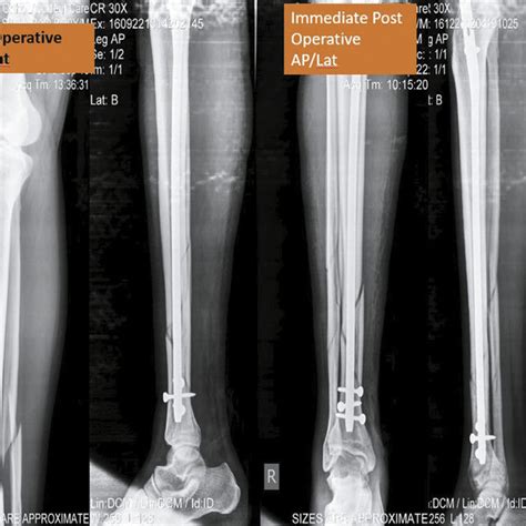 Fracture Of Lower Third Tibia Managed By Interlocked Nailing Showing