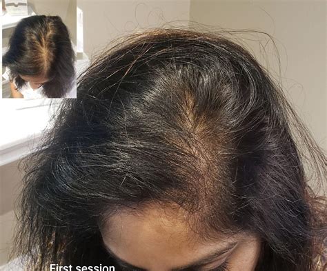 Scalp Micropigmentation For Women Scalp International Hairlines