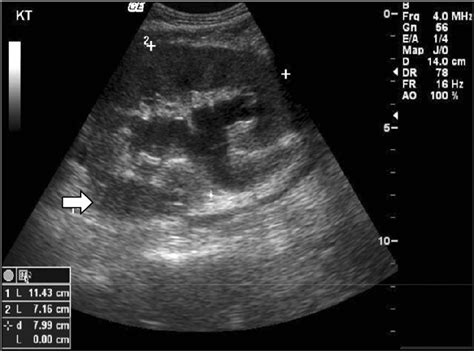 Renal Ultrasound Showing Hydronephrosis And Perirenal Fluid Collection