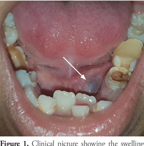 Figure 1 From Bluish Swelling On The Floor Of The Mouth Semantic Scholar