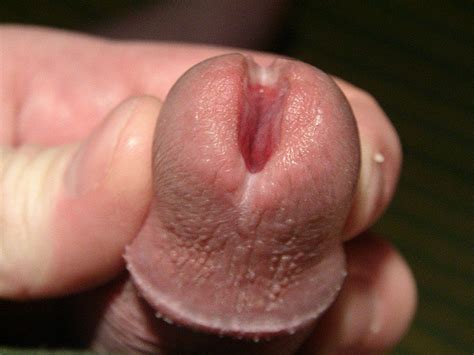 Very Large Glans Penis