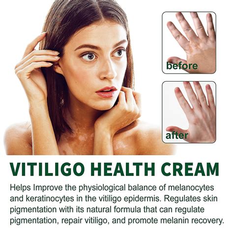 Vitiligo Cream Vitiligo Treatment For Skin Vitiligo Vitiligo Health