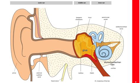 What Is Glue Ear — Ent4kids