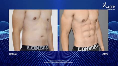 Vaser Liposuction For Men Xsculpt™