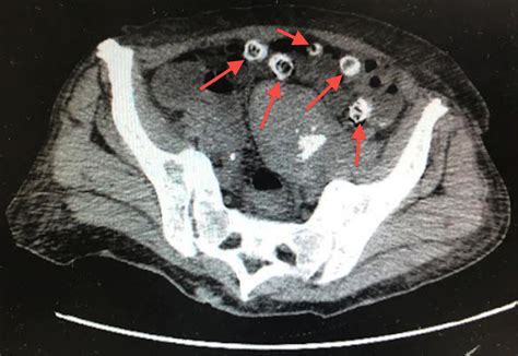 Cureus Calcified Diverticula In The Setting Of Per Rectal Bleed